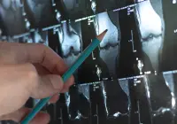 Doctor examining a knee MRI scan on a lightbox, pointing at the image with a pencil for diagnosis.&nbsp;