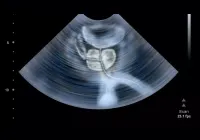 Transrectal ultrasound showing the prostate gland for urology imaging and diagnosis.&nbsp;