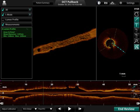 St. Jude Medical Announces European Approval of 3D Vessel Reconstruction Technology St. Jude Medical Announces European Approval of 3D Vessel Reconstruction Technology