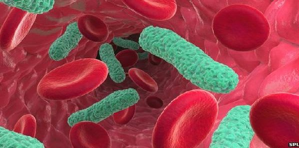 Gene Test for Rapid Sepsis Diagnosis Gene Test for Rapid Sepsis Diagnosis