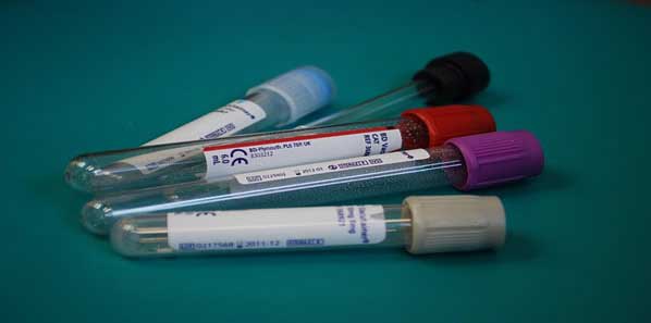 Blood Test Could Help Diagnose Schizophrenia Blood Test Could Help Diagnose Schizophrenia