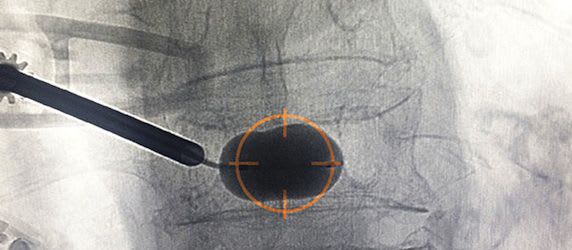 CareFusion Receives US FDA Approval for Vertebral Augmentation System CareFusion Receives US FDA Approval for Vertebral Augmentation System