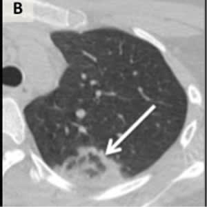 Axial CT Scan of Lung