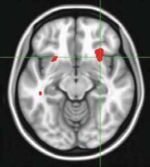 Scan Predicts Whether Therapy or Meds Will Best Lift Depression Scan Predicts Whether Therapy or Meds Will Best Lift Depression