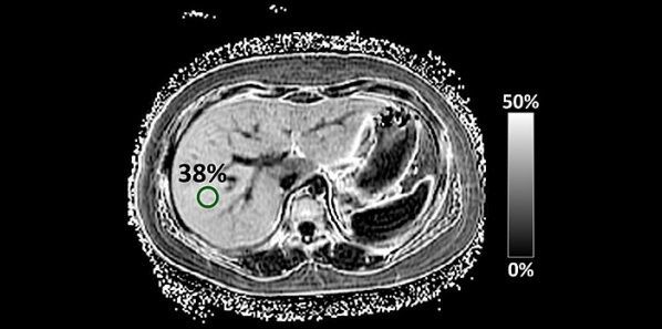 MRI Technique for NAFLD in Children MRI Technique for NAFLD in Children