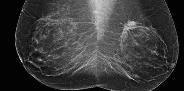 Norway Cancer Registry Expands Use of Volpara Solutions' Tools Norway Cancer Registry Expands Use of Volpara Solutions' Tools