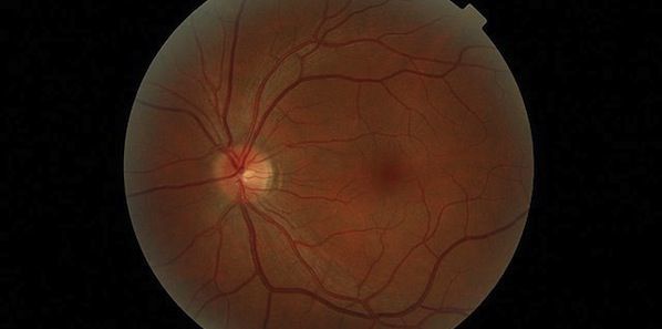 Noninvasive Retinal Imaging Tool For Alzheimer's Detection Noninvasive Retinal Imaging Tool For Alzheimer's Detection