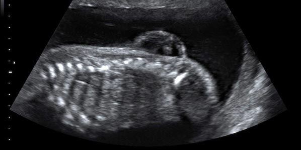 Tiny Prenatal Surgery Robot to Fight Spina Bifida Tiny Prenatal Surgery Robot to Fight Spina Bifida