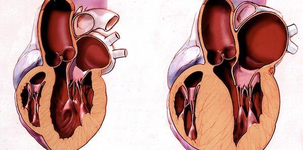 Cardiac Hypertrophy: Preventable via Protein