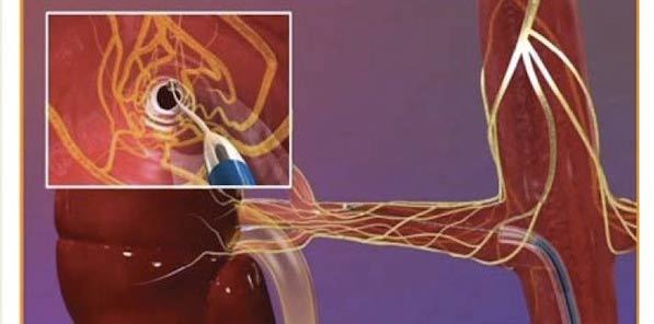Study: Renal Denervation Fails to Lower BP Study: Renal Denervation Fails to Lower BP