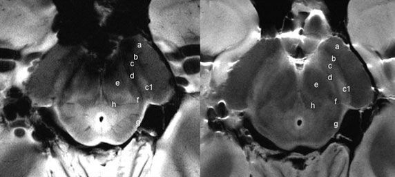 Study: 7-T MRI Offers Supporting Radiologic Diagnosis of Parkinson’s Disease Study: 7-T MRI Offers Supporting Radiologic Diagnosis of Parkinson’s Disease