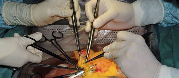 New Proposal for Improved Allocation of Liver Transplant Donations New Proposal for Improved Allocation of Liver Transplant Donations