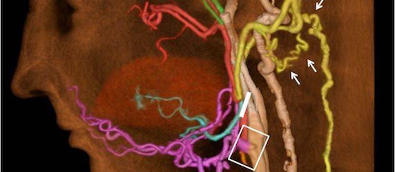 vessels scanner tumor blood Indiana breast