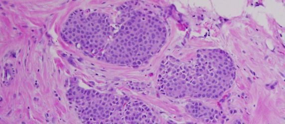 Some Women with Abnormal Breast Lesions May Avoid Surgery Some Women with Abnormal Breast Lesions May Avoid Surgery