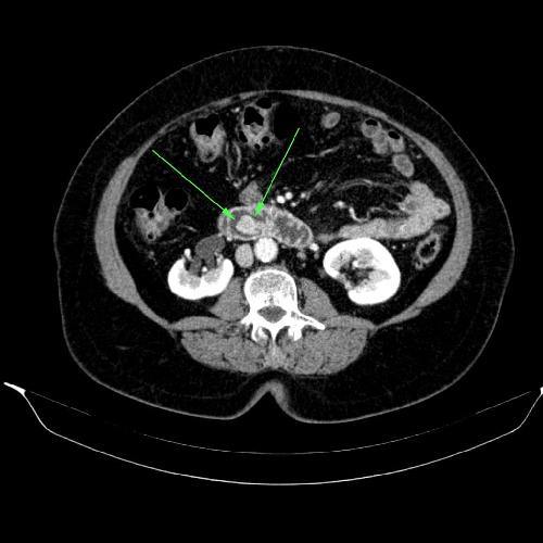 Pancreatic Cancer: MRI Protocol for High-Risk Patients Pancreatic Cancer: MRI Protocol for High-Risk Patients