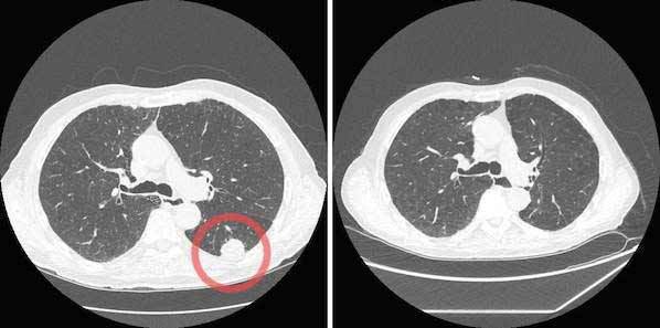 Medicare To Cover Low-Dose CT Screening for Lung Cancer