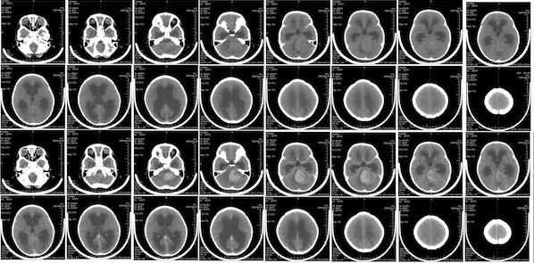Radiation Risks in Paediatric CT: An Evaluation Radiation Risks in Paediatric CT: An Evaluation
