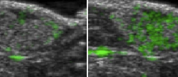 Improved Ultrasound Imaging Enables Tumour Visualisation Improved Ultrasound Imaging Enables Tumour Visualisation