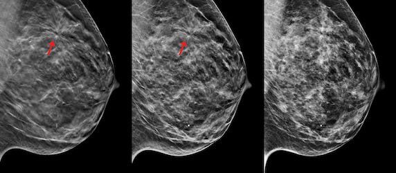 3d Mammography Named ‘hottest Clinical Procedure For The Fourth