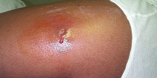 "Bio-floaters" in Antibiotic-Resistant Joint Infections "Bio-floaters" in Antibiotic-Resistant Joint Infections