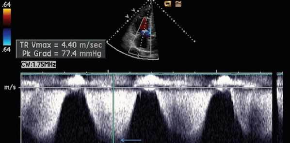 Measuring MPAP: Echocardiography Vs. Catheterisation Measuring MPAP: Echocardiography Vs. Catheterisation