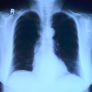 chest x-ray chest x-ray