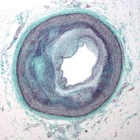 atherosclerosis, the most common form of CAD atherosclerosis, the most common form of CAD