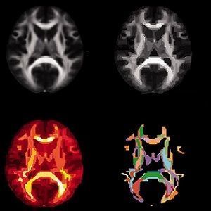 neonatal MRI and childhood cognitive outcome neonatal MRI and childhood cognitive outcome