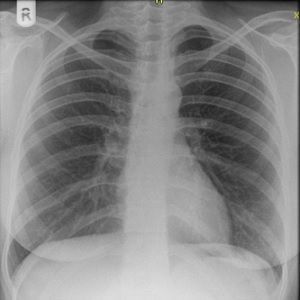 chest x-ray close-up chest x-ray close-up