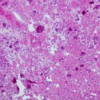 muscle tissue after sepsis muscle tissue after sepsis