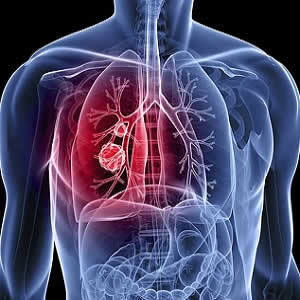 Lung Screening Could Reduce Lung Cancer Deaths Lung Screening Could Reduce Lung Cancer Deaths