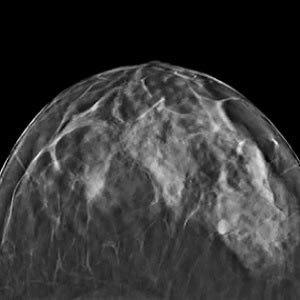 Tomosynthesis - Mammography of the Future? Tomosynthesis - Mammography of the Future?