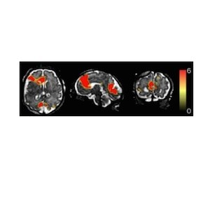 Mapping the Fetal Brain: New Technique Mapping the Fetal Brain: New Technique