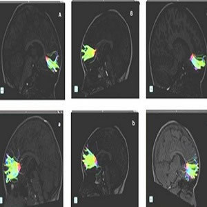 Fibers belonging to the greater forceps pre-musical training are observed (A, B, C). Fibers belonging to the same patients after 9 months of musical training are observed below (a, b, c). Fibers belonging to the greater forceps pre-musical training are observed (A, B, C). Fibers belonging to the same patients after 9 months of musical training are observed below (a, b, c).
