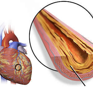 Is PCI Safe for Patients Undergoing TAVR? Is PCI Safe for Patients Undergoing TAVR?