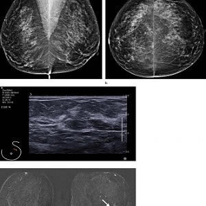Images in a 55-year-old screening participant. (a, b) Normal digital full-field mediolateral oblique (a) and craniocaudal (b) mammograms (BI-RADS category 1) show a heterogeneously dense breast (ACR category C). (c) Screening ultrasound image shows normal Images in a 55-year-old screening participant. (a, b) Normal digital full-field mediolateral oblique (a) and craniocaudal (b) mammograms (BI-RADS category 1) show a heterogeneously dense breast (ACR category C). (c) Screening ultrasound image shows normal