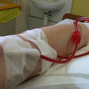 Study: Kidney Damage Diagnosis May Be Inaccurate for Many Study: Kidney Damage Diagnosis May Be Inaccurate for Many
