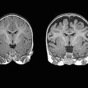 Right: MRI of a baby at 6 months who was diagnosed with autism at 2 years. The dark space between the brain folds and skull indicate increased amounts of cerebrospinal fluid. Left: MRI of a baby who was not diagnosed with autism at age 2. Note the decreas Right: MRI of a baby at 6 months who was diagnosed with autism at 2 years. The dark space between the brain folds and skull indicate increased amounts of cerebrospinal fluid. Left: MRI of a baby who was not diagnosed with autism at age 2. Note the decreas