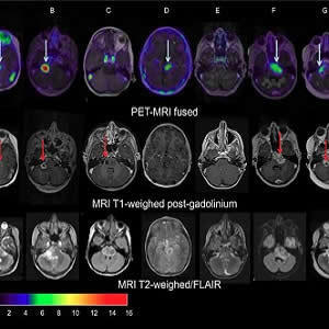 PET/CT Predicts Therapy Effectiveness in Paediatric Brain Tumours PET/CT Predicts Therapy Effectiveness in Paediatric Brain Tumours