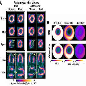 Panel A shows representative short and long-axis PET images of peak myocardial uptake of 13N-ammonia during hypercapnia of PaCO2 ~ 60 mmHg (CO2), standard clinical dose of adenosine (Adenosine) and at rest with PaCO2 ~ 35 mmHg (Rest) in a canine with a LA Panel A shows representative short and long-axis PET images of peak myocardial uptake of 13N-ammonia during hypercapnia of PaCO2 ~ 60 mmHg (CO2), standard clinical dose of adenosine (Adenosine) and at rest with PaCO2 ~ 35 mmHg (Rest) in a canine with a LA