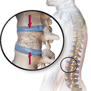 Radiology of Vertebral Fractures in Women and Men Radiology of Vertebral Fractures in Women and Men