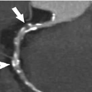 Improving Coronary Plaque Visualisation in Coronary CTA Improving Coronary Plaque Visualisation in Coronary CTA
