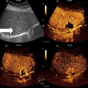 Contrast-enhanced ultrasound for detecting combined hepatocellular cholangiocarcinoma Contrast-enhanced ultrasound for detecting combined hepatocellular cholangiocarcinoma