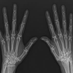 Ultrasonography in monitoring chronic rheumatoid arthritis Ultrasonography in monitoring chronic rheumatoid arthritis