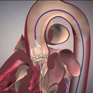 Length of hospital stay impacts outcomes post TAVR Length of hospital stay impacts outcomes post TAVR