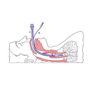Tracheal intubation in critical care - expert guidelines Tracheal intubation in critical care - expert guidelines