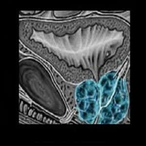 Biparametric MRI improves prostate cancer detection Biparametric MRI improves prostate cancer detection