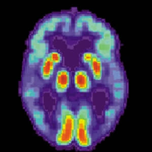 Amyloid PET improves evaluation of patients with cognitive impairment Amyloid PET improves evaluation of patients with cognitive impairment