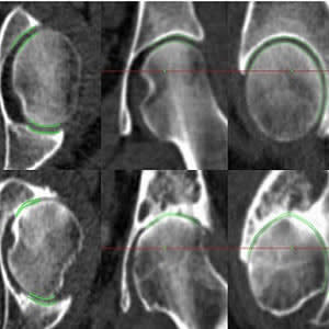 JSM performance at the extremes of disease. Joint space margins are shown in green as seen in axial, coronal and sagittal planes (left to right) at two left hips. (a) An individual with a radiographic K&amp;L grade of 0 (no disease) and minimum joint space wi