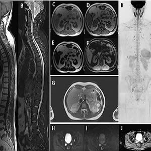 Illustration of the images acquired in the WB-MRI protocol. Whole-spine sagittal fast-spin-echo T1w (A) and T2w fat-suppressed (STIR) (B) images. Whole body (skull base to mid thighs) axial T1w thin-slice gradient-echo Dixon technique with in-phase (C), o Illustration of the images acquired in the WB-MRI protocol. Whole-spine sagittal fast-spin-echo T1w (A) and T2w fat-suppressed (STIR) (B) images. Whole body (skull base to mid thighs) axial T1w thin-slice gradient-echo Dixon technique with in-phase (C), o